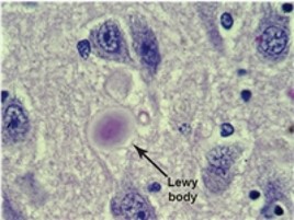 En bild på Lewy kroppar i hjärnan